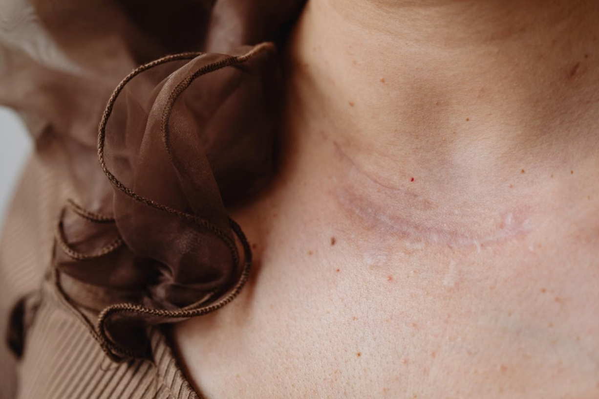How Modern Surgery Prevents Scar Tissue Buildup